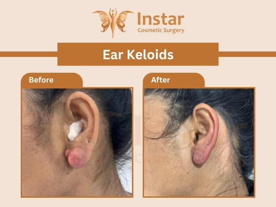 Ear Keloids-3